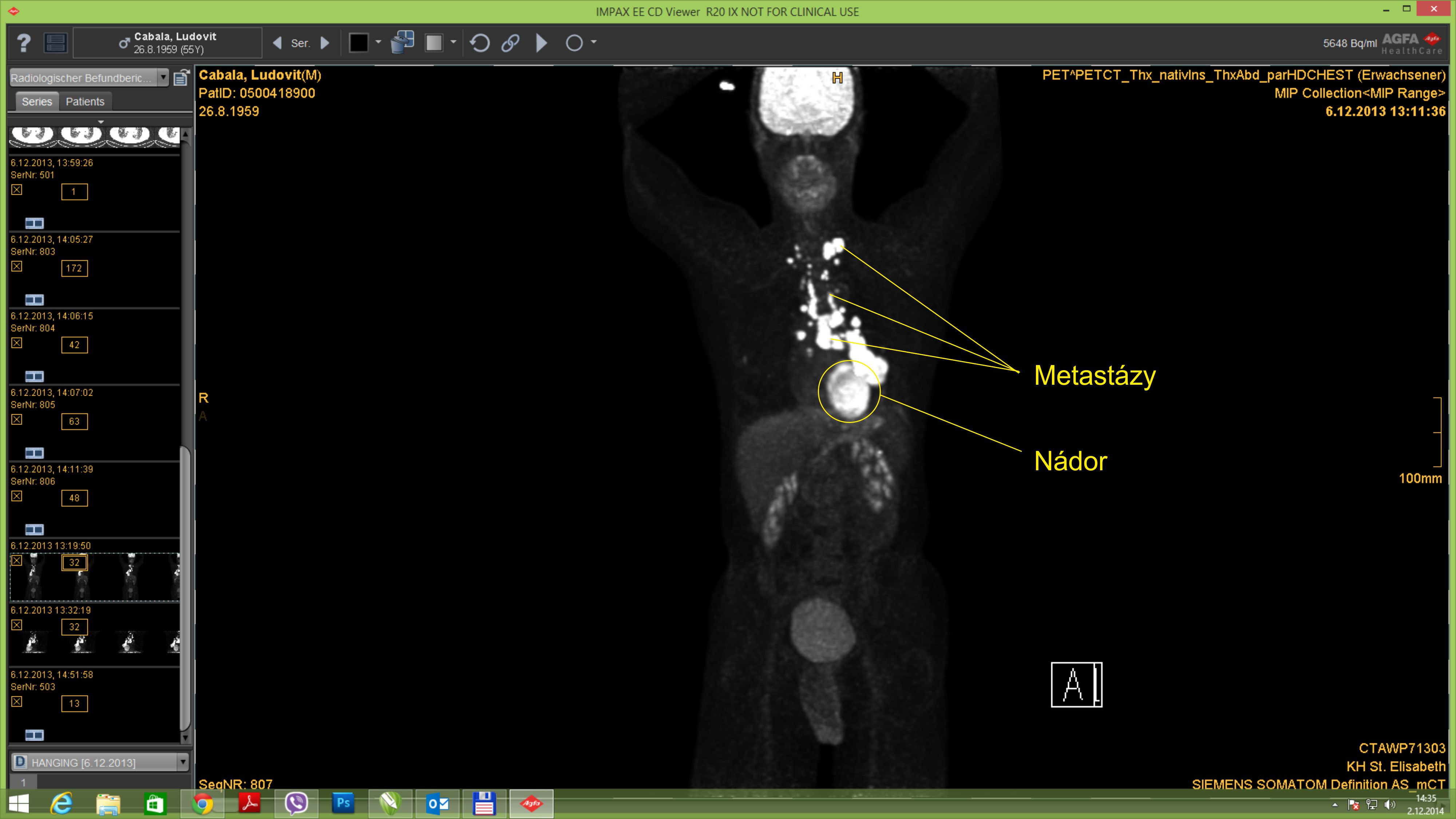 nádor s metastázami 6.12.2013 klik na obrázok